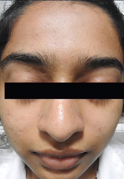 Acne-AfterBig